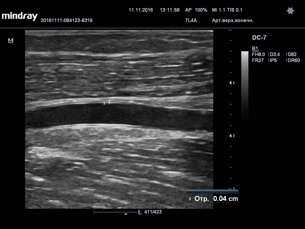 Brachial artery. Where is located, anatomy, branches, bleeding, thrombosis, damage, ultrasound, consequences