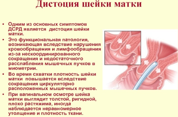 Distocia colului uterin. Ce este, clasificare, orientări clinice