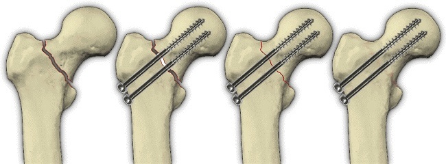 Femoral neck. Where is the person, the symptoms of fracture, fracture, necrosis, dislocation, treatment, surgery, rehabilitation