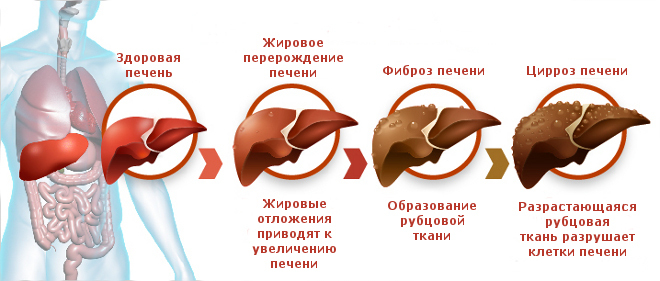Cirrhosis of the liver. Symptoms in women, men, diagnosis, causes, drug treatment