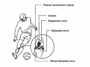 causes of knee injuries