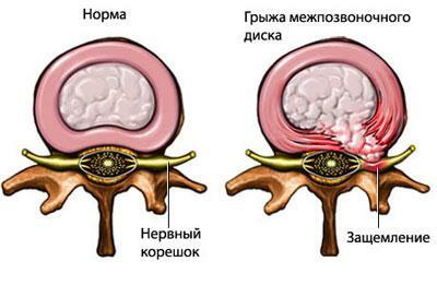 Schematic representation of a herniated intervertebral disc