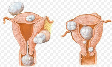 Mioma submous uterus