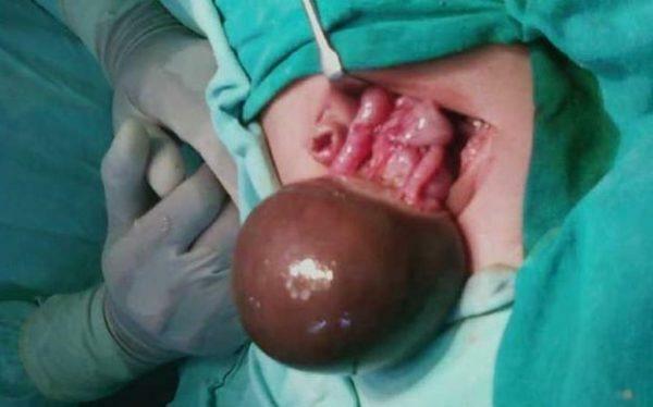 The operation to remove the cyst of a huge ovary - photo