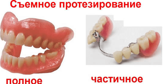 Arten von Zahnersatz