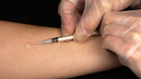 vaccin împotriva tuberculozei