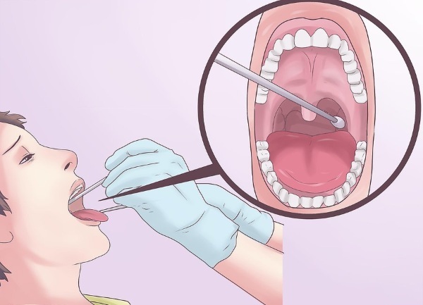 Throat swab for infections. What is the name, where to pass, how to prepare