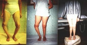 Dysplázia kolenného kĺbu: ako zabrániť a vyliečiť?