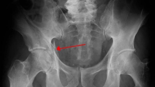 Sacroiliitis of the sacroiliac joint. Symptoms and treatment, what is it, degree