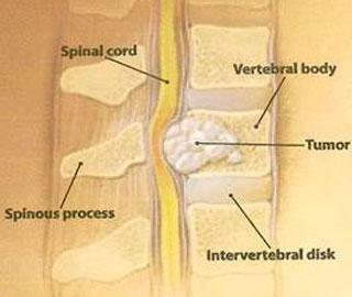 Compression of the spinal cord