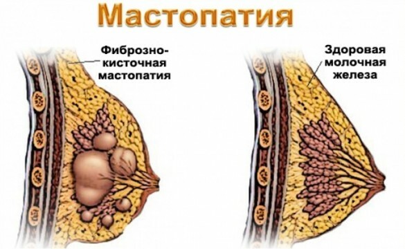 Fibrous-cystic mastopathy