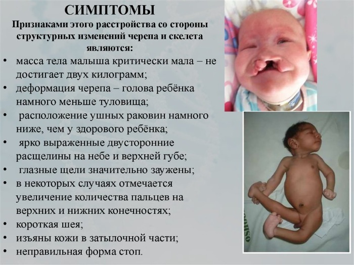 Trisomia 13 (sindrome di Patau). Indicatori normali, cosa significa in donne in gravidanza, feto, rischio, cause