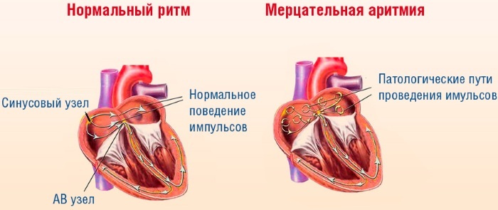 Blood thinners, strengthening the walls of blood vessels without aspirin for atrial arrhythmia. List of new generation
