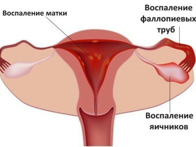 Desen, durere dureroasă la nivelul abdomenului inferior la femei: cauze