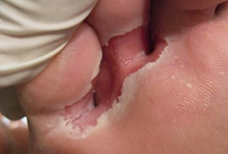 Foto da micose da pele do pé entre os dedos dos pés