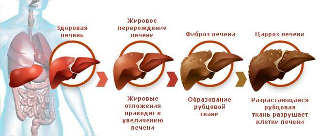 Stages of cirrhosis of the liver