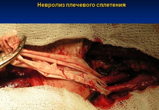 Neurozinis brachialinis verpimas