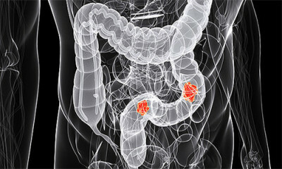 Inflammation of the sigmoid colon( sigmoiditis): symptoms, treatment, drugs