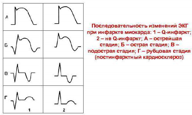 Cicatricial changes in the myocardium on the ECG