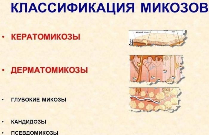 Mycosis of the skin. Photos, symptoms and treatment of the head, face, hands, body