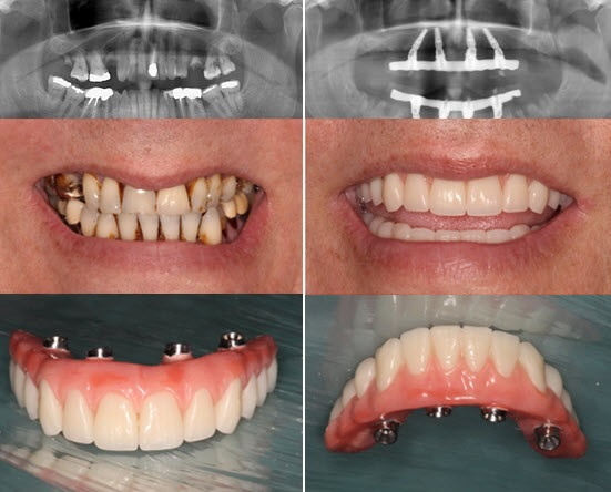 Fixed prosthesis on 4 implants. Price, can I put