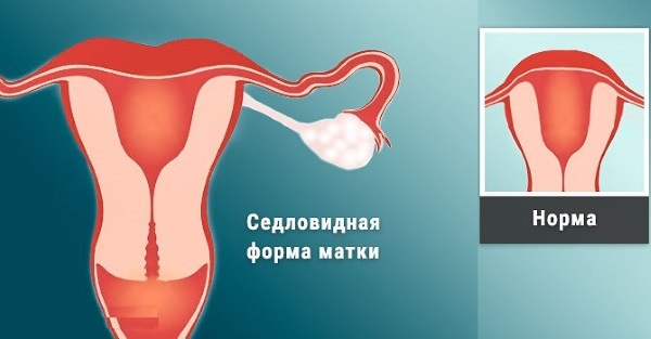 Uter de șa. Ce este, ce înseamnă în timpul sarcinii, RMN, ultrasunete, tratament