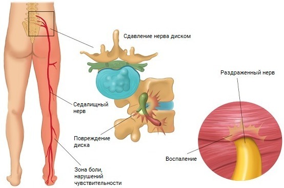 Sidal nerve. Betennelsessymptomer, behandling, injeksjoner