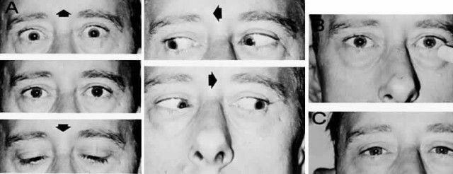 Síndrome de Parino - por que há paralisia do olho vertical?