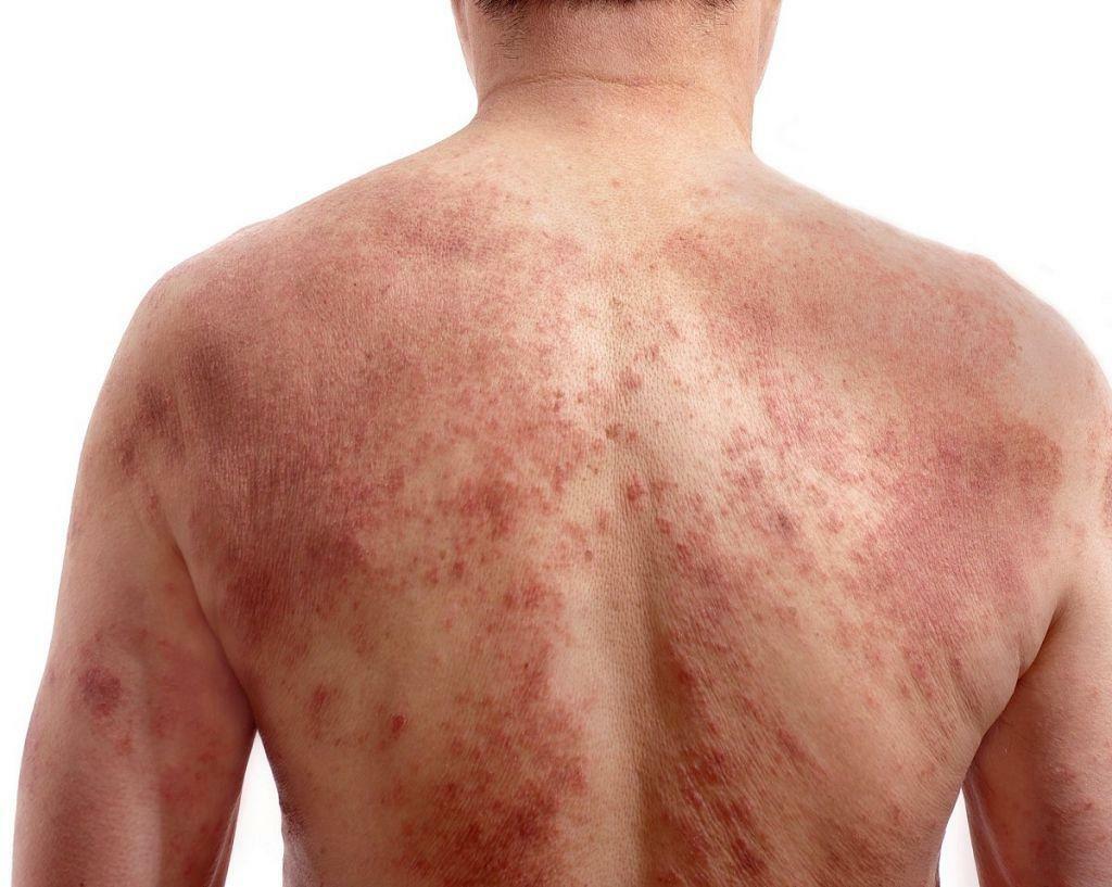 Treatment of herpes zoster in the elderly - detailed treatments