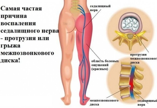 Pinched nerve in the lower back. Symptoms in women, treatment
