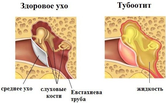 Tubo-otitis. Symptoms and treatment in children, adults, clinical guidelines
