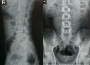 Røntgen af ​​rygsøjlen
