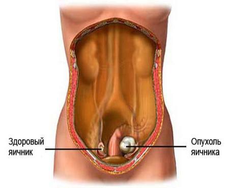 Nymphomania se lahko pojavi zaradi tumorja jajčnikov