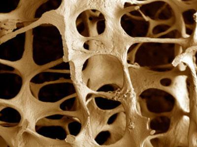 Hueso afectado por osteoporosis
