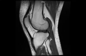 sprain of the knee