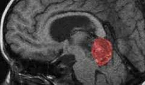 Germinoma - a rare tumor of the penial region of the brain