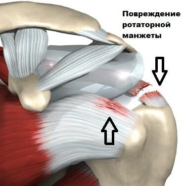 Shoulder tendon rupture. Treatment after surgery with folk remedies, symptoms, how long it takes to heal