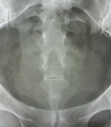 Human tailbone. Anatomy, where it is, functions, how and why it hurts