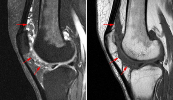 Artritis koljena. Liječenje 1-2 stupnja, lijekovi, masti