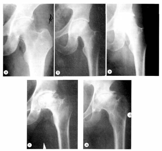 Stadia nekrózy na rentgenovém snímku