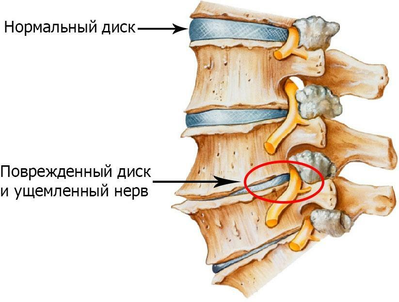 Osteochondrosis lumbar