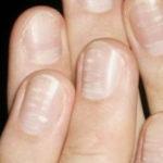Cyanotisk nyans av nagelplattan och huden runt