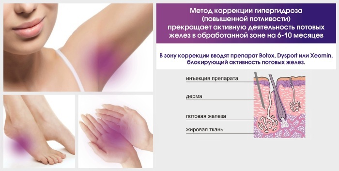 Hyperhidrosis of the palms and feet. Laser treatment, folk remedies, botox, causes
