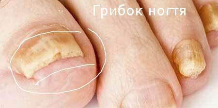 Behandeling van nagel schimmel thuis met folk remedies