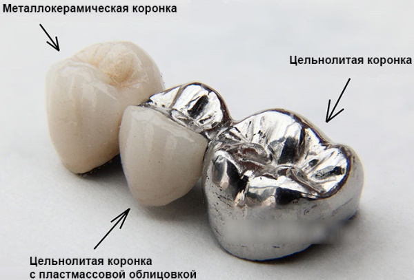 Tooth crowns. Types, which are better, pros, cons, prices