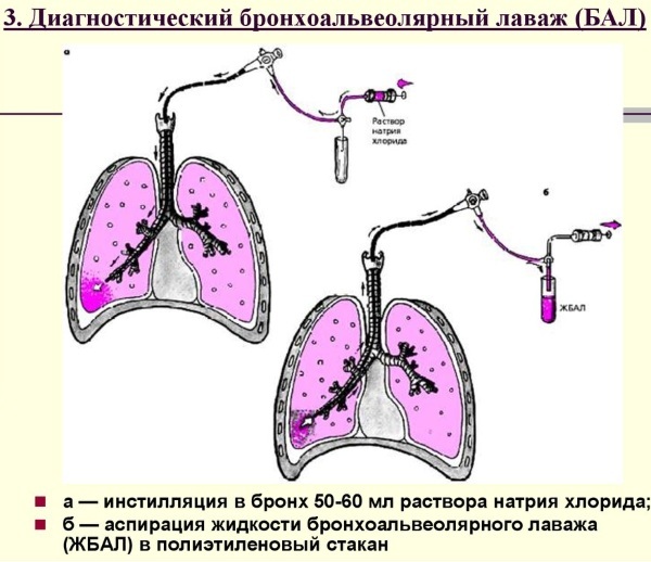 Atoopiline bronhiaalastma. Mis see on, kliinilised juhised, ravi