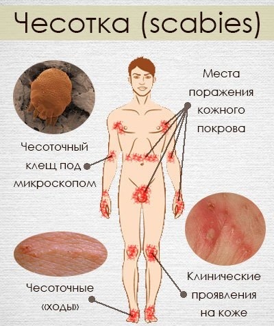 Scabies treatment on humans. Photos, symptoms, treatment at home