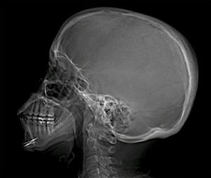 radiografie van de schedel
