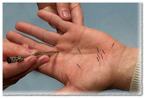 Acupuncture( acupuncture)