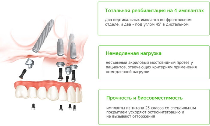 Festsitzende Prothese auf 4 Implantaten. Preis, kann ich liefern, Design